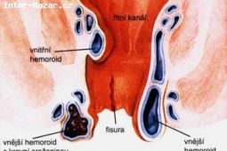 Trápí vás hemeroidy?